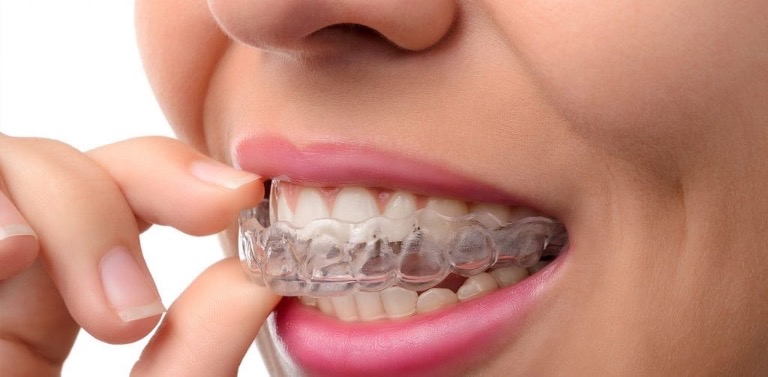 photo of someone putting invisalign on